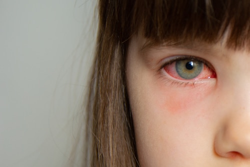 Knowing What Pink Eye Looks Like